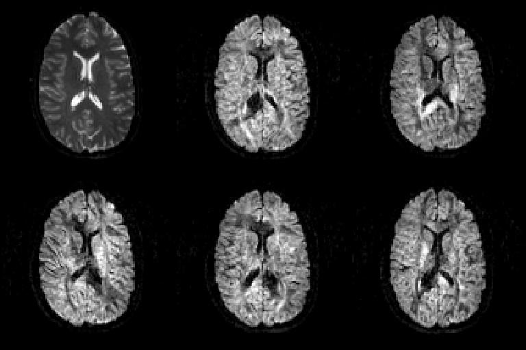 3.4 DTI: Avbilding av anisotropt diffunderende partikler 23 Figur 3.4: b 0 -bildet øverst til venstre [0,0,0], de andre representerer diffusjonsvektede opptak med ulike gradientretninger G = [-0.
