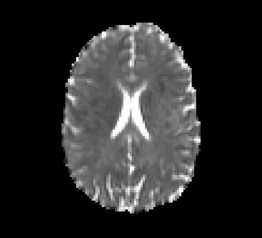 30 MR-basert diffusjonsavbilding Figur 3.7: Eksempel på MD-kart med diffusjonsvektingen b = 500 s/mm 2. Kartet viser at det er sterkest signalintensitet der det er størst diffusivitet.