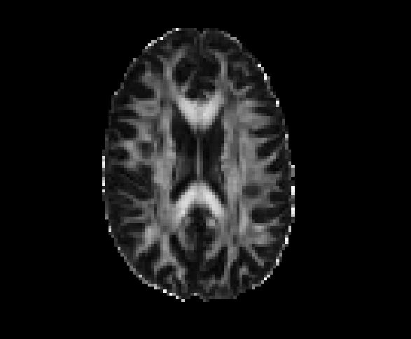 3.8 Artefakter 3 Figur 3.8: Eksempel på FA-kart med diffusjonsvektingen b = 500 s/mm 2. Kartet viser hvit hjernesubstans som lysgrå og hvit og grå hjernesubstans som mørkgrå og svart.
