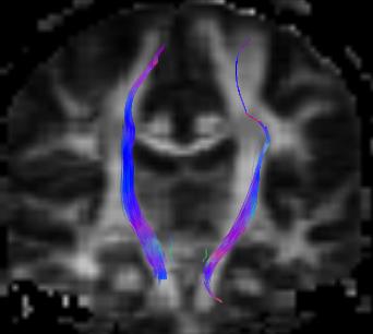 3.0 Traktografi 35 3.0 Traktografi Traktografi er et analyseverktøy som skaper en indirekte visualisering av nervefibrene i hvit (og grå) hjernesubstans.