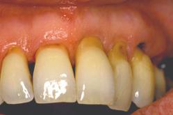 Stabilisert periodontal sykdom med stor gingival retraksjon Initiale rotkarieslesjoner