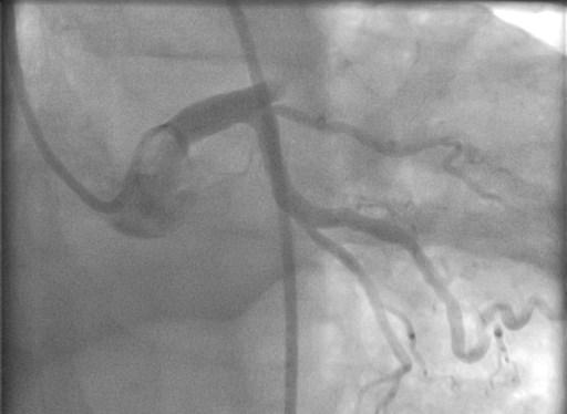 STEMI 13