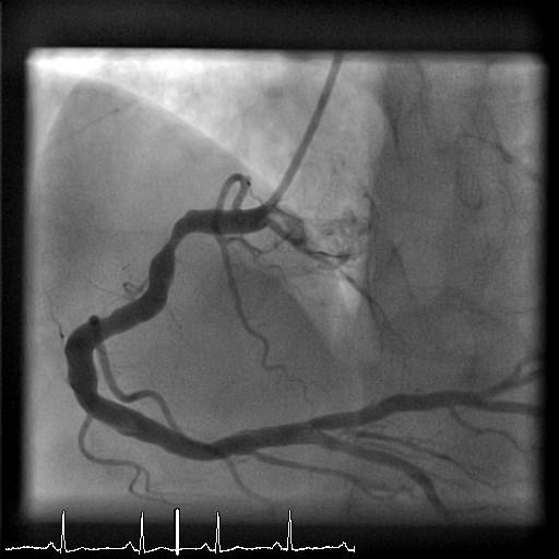 48 år gammel mann STEMI fremre vegg desember 2015 Prehospital trombolyse Rescue PCI av LAD Dominant RCA Hva så?