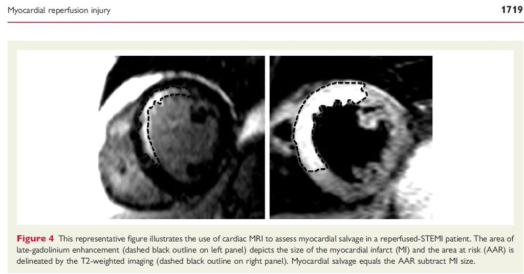 Myocardial salvation index Infarct size