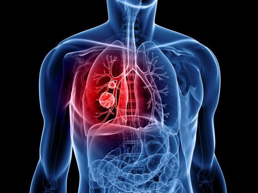 Lungekreft Risikofaktorer Røyking og passiv røyking Asbest Symptomer Langvarig hoste Blodig oppspytt Tungpust Stadige lungebetennelser Diffuse smerter Nedsatt almentilstand Lungekreft Behandling Hvis