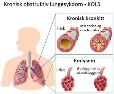 KOLS: Kronisk obstruktiv lungesykdom Bind 1 s 72-73 Samlebetegnelse for kronisk bronkitt og emfysem Lignende sykdom som astma, men er kronisk i motsetning til astma.