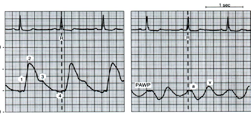 Lungekateter EKG +