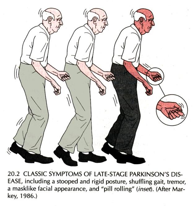 Ekstremt nedsatt motorisk kontroll hos pasienter med Parkinson s sykdom (PD) Klassiske symptomer på fremskreden PD -