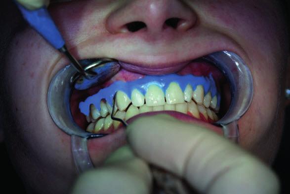 mindre risiko for feil Bonder til tand,