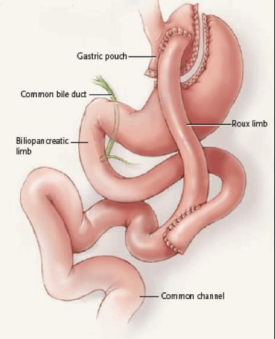 Gastric bypass Overvektskirurgi 20-30 cm3 ventrikkelpouch 120