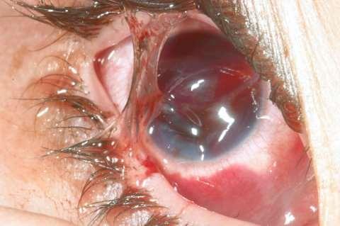 Skader i øyet Perforasjon : penetrerende sår med og uten