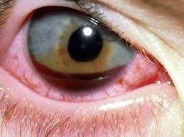 Stump skade mot øyet (kontusjon av øye) Funn: Redusert syn.