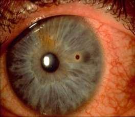 Fremmedlegeme på øyet Anamnese: vinkelsliper / fått noe på øyet Sympt: rødt øye, smerter, fotofobi Funn: rødt øye, fargeopptak ved fluorescein, fremmedlegeme på hornhinne Behandling: Bedøve med