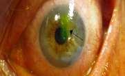 Nylig skade mot øyet (finger, gjenstand, kvist, etsende stoff, kontusjon, kontaktlinsebruk)?