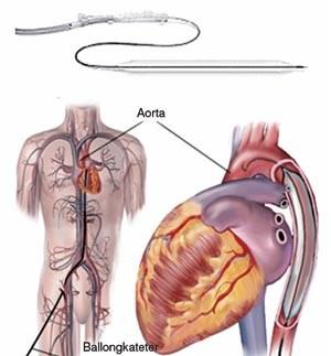 Intra Aortic Balloon Pump Indikasjoner: Kardiogent sjokk/myokardsvikt etter infarkt?