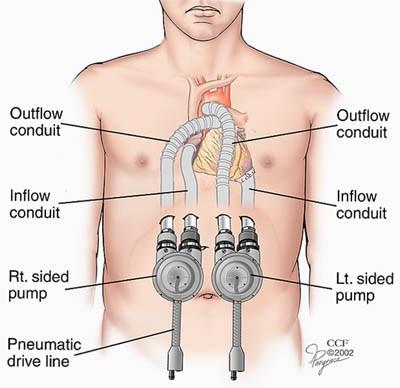 Left Ventricular