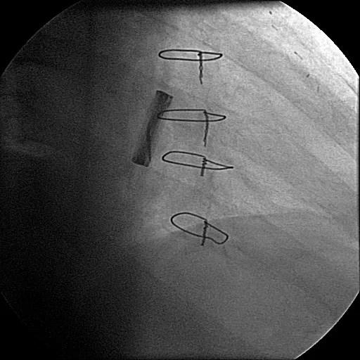 Andre årsaker til kardiogent sjokk 1. Hypertensiv hjertesykdom 2. Klaffefeil 1. Akutte insufficienser (aortadisseksjon, endokarditt, chordaruptur) 2. Mitralstenose, aortastenose 3. Ventiltrombose 3.