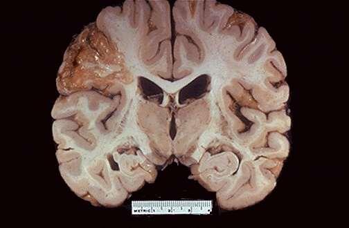 Hjerneinfarkt i fremre/øvre gren av midtre hjernearterie