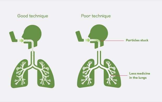 10. INHALASJONSMEDISINER Ta med inhalasjonsmedisiner Hvordan fungerer medisinene?