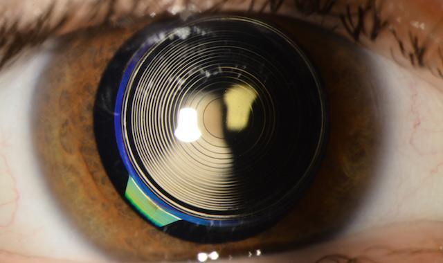 Forventninger og muligheter Best resultat når en del katarakt og fravær av andre øyesykdommer Kataraktopersjon når ikkekatarakt? CLE Clear lense extraction Ved. f.eks.