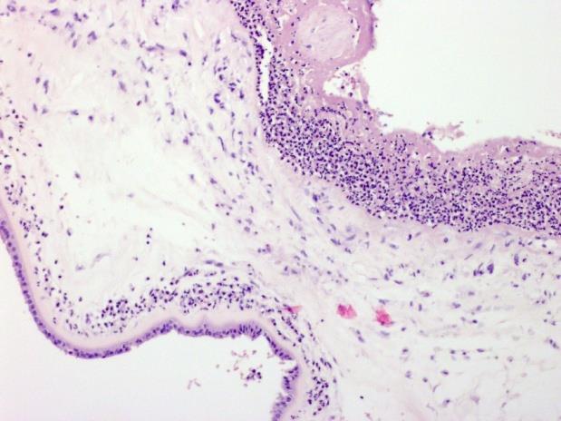 Placenta morphology Inflammasjon Sirkulasjonsforstyrrelser Modningsavvik Klassifisere