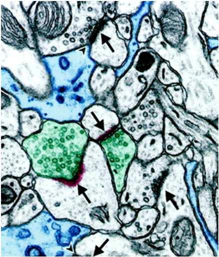 Glutamatsynapser sett i elektronmikroskopisk snitt Nerveterminal med små, klare vesikler Dendritt spina med postsynaptisk