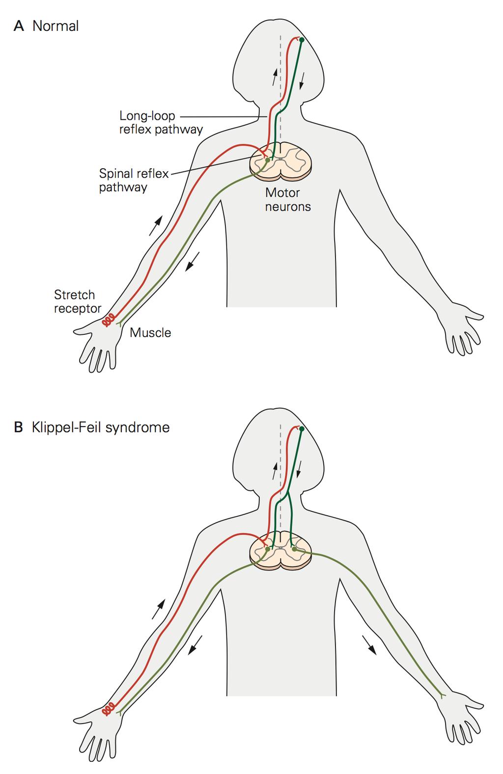 Sene reflekssvar langlatensstrekkereflekser (som involverer supraspinale områder) Illustrert ved Klippel-Feil syndromet A Normal Supraspinale områder (cortex) A.