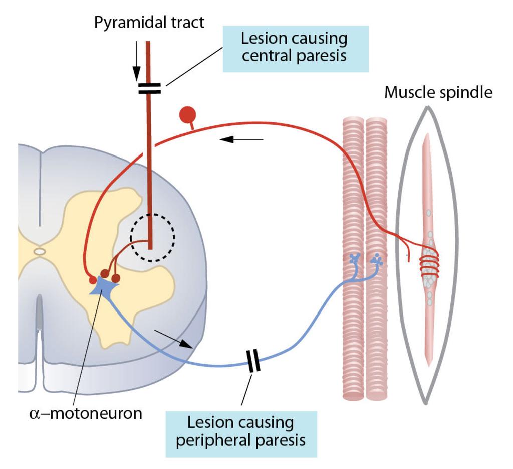 Sentral og perifer lammelse (parese) Pyramidebanen Skade som gir sentral parese Muskelspole Sentral lammelse: Affeksjon av øvre motonevroner eller deres nedstigende forbindelser til nedre