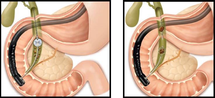 trekkes ut i duodenum.