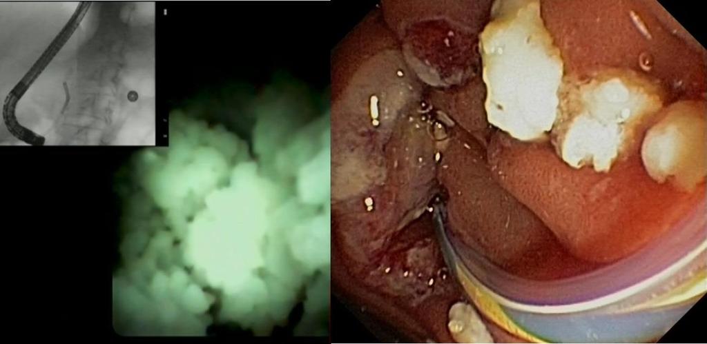 Bilde 21. Ductoskopisk bilde av pankreasstein og steinfragmenter i duodenum etter uthenting 5.