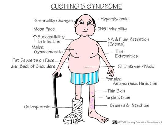 Cushing syndrom, forts. Behandling Avslutte kortisonbehandling, dersom dette er årsaken. Fjerning av svulsten i hypofysen ved kirurgi eller stråling.