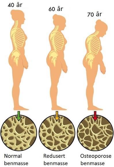 Osteoporose, forts.