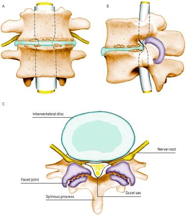 Lumbal spinal stenose Eric Franssen Kir Ort Klinikk SUS