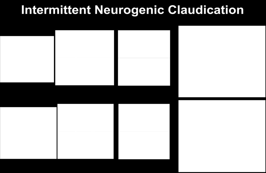 the area (Inufusa et al. Spine 1996) Symptomatologi Nevrogen intermitterende claudicatio uni/bilateral.