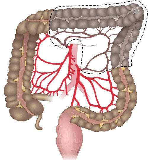 Tumor i venstre del av transversum og venstre fleksur Colica media settes av sentralt.