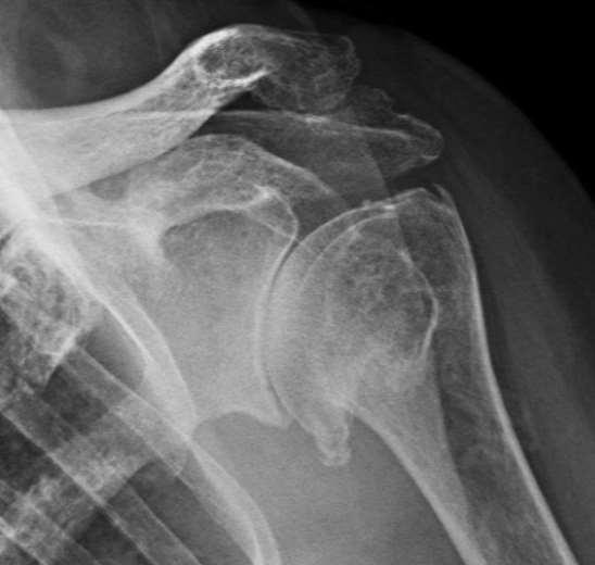 inferior humeral or glenoid 2 Moderate 3-7 mm osteophytes, slight