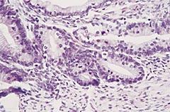 Figur 3 Lysmikroskopisk bilde av formalinfiksert, parafininnstøpt HE-farget vevssnitt fra ovarietumor med atypisk mucinøst cystadenom Tabell 1 Resultat fra immunkarakterisering av pleuravæske