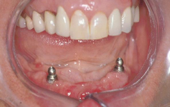Underkjeve: Hel tannprotese (gebiss) festet på implantater Tannprotesen tas ut og