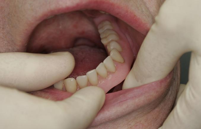 Tannproteser (gebiss) i begge kjever Tannprotesene/gebissene og munnhulen bør rengjøres 2