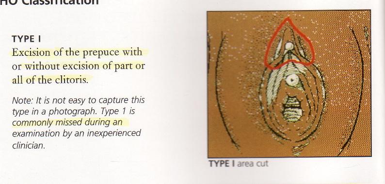 WHO Type I Fjerning av forhuden på klitoris, med eller uten delvis eller fullstendig