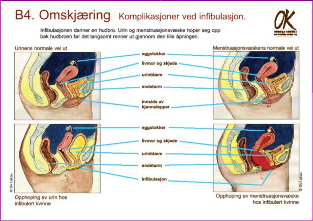 Menstruasjonssmerter 67% Langsom/smertefull vannlating 58% Gammelt mens.