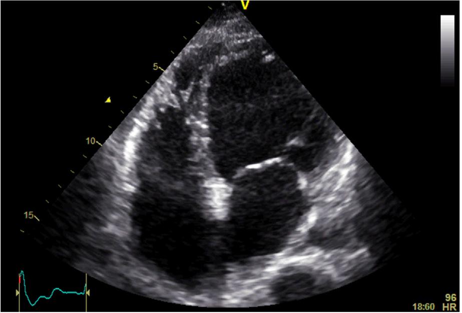 Figur 1. Kvinne, 53 år, med dystrofia myotonika type 1 med symptomatisk muskeldystrofi.