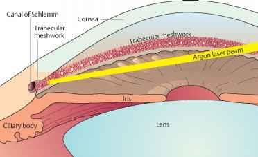 Behandling - laser Laser iridotomi