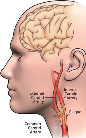 Carotis arterie stenose Prevalens 3% alder 25-85 år (Tromsø studie) 10% over 70 år Risiko for hjerneinfarkt øker med økt stenosegrad Årlig risiko for