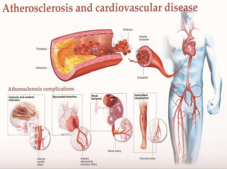 Risikofaktorer av aterosklerose Multifaktoriell sykdom