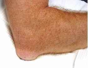 Albuesmerter generelt Smerter i området rundt albuen, oftest pga skader eller overbelastninger. Smertene forekommer hyppigst på utsiden av albuen lateral epikondylitt eller tennisalbue.