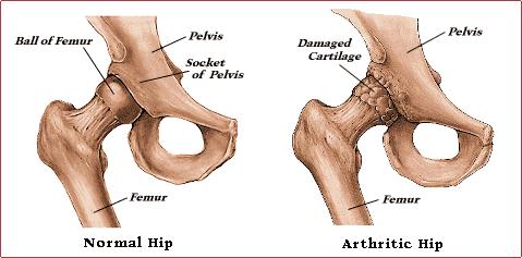 Artrose Artrose er slitasjeforandringer i hofteleddet. Det er vanligvis forårsaket av høy alder og i Norge settes det inn ca. 6500 hofteproteser.