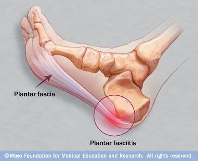 Plantarfascitt Plantarfaschian er en seneplate på undersiden av foten. Den har utspring fra forkanten av hælbenet og brer seg i vifteform frem til tærne.