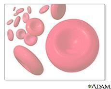 Anemi grunnet hemming av benmargen Generell hemming av benmargen og dermed produksjon av røde blodceller, pga annen alvorlig sykdom.