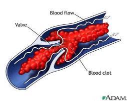 Blodpropp: Trombose og emboli Bind 1 s 106-107 Dannelsen av et blodkoagel inne i blodårene som fører til at blodstrømmen i blodåren stoppes.